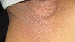 Annular plaque of the groin measuring 8 cm.