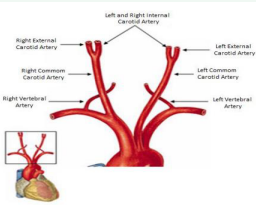 Graphical representation of carotid artery branches (Netter,  2000)