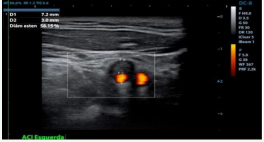 Cross-sectional image of the left internal carotid artery, with  measurement of 50-59% stenosis caused by a carotid plaque; “ACI  Esquerda” stands for left internal carotid artery.