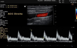  Longitudinal image of the carotid artery, with the flow  displayed through the color scale and the spectral speed; “ACC Direita”  stands for right common carotid artery