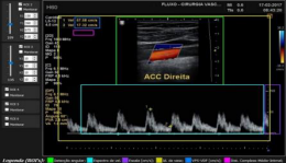  Example of selecting regions of interest at Doppler  measurement for the right common carotid artery
