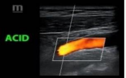 Region of Interest for Detecting the Insonation Angle; “ACID”  is the right internal carotid artery