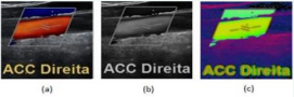 Application of color filters. (a) Original image; (b) Gray  image; (c) HSV image; “ACCD” stands for right common carotid artery.