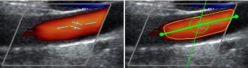  Comparison between the positioning of the cursor during  the exam (on the left) and the automatic adjustment (on the right)