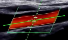  Angle of insonation - Example of results obtained after  collecting data and performing calculations.