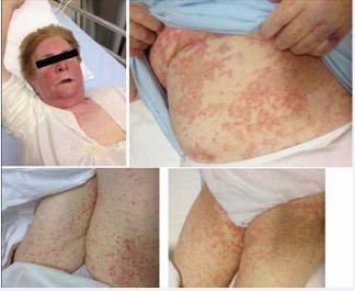 Patient, topographic distribution of the rash.