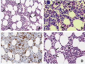 Bone marrow biopsy.  A: The bone marrow parenchyma showed mild increase of hemopoietic  cellularity and discrete degree of eosinophilia (arrows). Hematoxilyn eosin stain, x200.   B: Giemsa staining showing the increase of the abundant mature  (arrow) and immature (arrowhead) eosinophil granulocytic  component. Giemsa stain, x400.  C: Immunochemical staining with anti-CD68 highlights the increase  of histiocytes with diffuse signs of hemophagocytosis. CD68 PG-M1,  x200.  D: Presence of myeloid precursors (arrows) within a dilated sinusoid  (intravascular hemopoiesis). Hematoxilyn-eosin stain, x200.