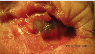 Patient with basal cell of the lower eyelid without treatment  in stage 4 coming to our Dept. with infiltration of the orbit (author  A. Furdova, Dept of Ophthalmology, Medical School Comenius Univ.,  Bratislava).