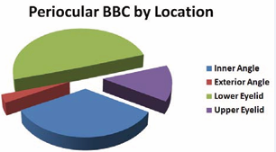 Localization of the periocular BCC in patients treated for  basal cell carcinoma at Dept. of Ophthalmology, Medical School,  Comenius University in Bratislava in period 2012 – 2013.