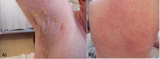 Figure demonstrating tense clear filled bullae on the background of erythematous plaque on the axillae (A) and inframammary region (B)  urticarial papules and plaques on the back.