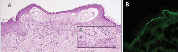 (A) Cutaneous biopsy demonstrating subepidermal blistering formation with distended papillae and nuclear dust (H&E X100) (B) Higher  magnification showing neutrophils and subepidermal spilt (H&E X400)(C) Direct immunofluerences showing continuous linear deposition of Ig A  along the basement membrane zone.