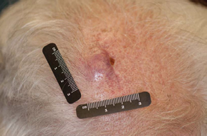 Wang C, Tran C, Duvic M (2015) A Case of Cutaneous Diffuse Large B-Cell Lymphoma and Concurrent Follicular Lymphoma In-situ J Dermatolog Clin Res 3(1):  1038.
