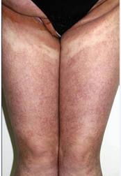 Erythematous, symmetric plaques of groins and thigs with morbiliform surface. Courtesy of Centro Dermatologico Federico Lleras. Bogotá.