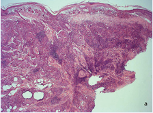 Skin biopsy of the trunk. Panoramic view showing granulomatous infiltration of dermis and hypodermis with abundant giant cells and lymphocytes.