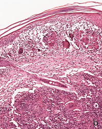 Sub epidermal granulomas rich in giant cells with lymphocytes, some of which penetrate the basal epidermis.