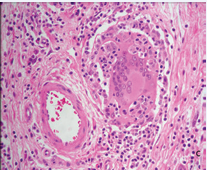 A giant cell of the infiltrate has numerous nuclei, is surrounded by mononuclear cells and has several lymphocytes in its cytoplasm (emperipolesis). A-C: HE. A, 2.5X B, 10 X. C, 40X.