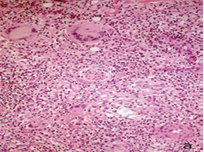 A nerve in the center of the figure has dispersed perineurium and is surrounded by a giant cell. The peripheral infiltrate has many giant cells with numerous nuclei, lymphocytes and eosinophils.