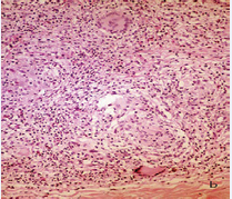 \These nerves (lower right B) have no defined perineurium and are surrounded by diffuse infiltrate of macrophages, giant cells, lymphocytes and eosinophils