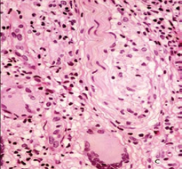 These nerves have no defined perineurium and are surrounded by diffuse infiltrate of macrophages, giant cells, lymphocytes and eosinophils. Vacuolated macrophages seem to be endoneural