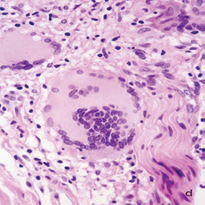 This nerve does not show perineurium and is surrounded by prominent giant cells, but looks well preserved. A-D: HE. A, B: 16 X. C, D: 40 X.