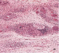 This nerve is surrounded by granulomas and lymphocytes but its structure looks normal.