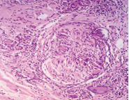 It is not easy to determine if this nerve is being infiltrated and destroyed by the cellular reaction or if it is simply surrounded by it.