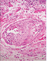 Well preserved nerve with a giant cell, scant macrophages and some lymphocytes in the endoneurium. A-C: HE. A,10 X. B, 16 X. C, 40 X.