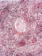 These nerve bundle, located at the center of the granulomatous infiltrate, looks quite normal. This image is improper of leprosy. HE, 20X.