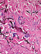 Elastic stain demonstrates giant cells phagocytosing elastic fibers. A: HE, 20X. B, 40 X.