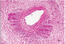 Medium size vein surrounded by abundant giant cells and lymphocytes.