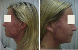 The patient before the isotretinoin treatment.