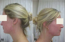 The patient after the isotretinoin treatment