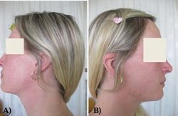 The patient after repeated dermaroller treatments