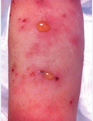 Typical manifestation of bullous pemphigoid with tense,  serous bullae based on erythematous and urticarial lesions.