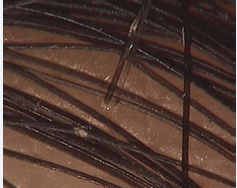 Area of nodular formations causes  transverse fissures,  where the hair can break off completely (70x).