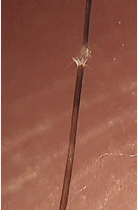  Figure 3 Hair shafts which split longitudinally into numerous small  fibers, producing a picture that resembles two brushes aligned in  opposition (70x)..
