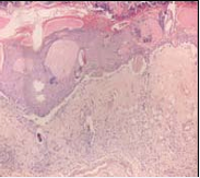 H&E-stained sections on day 7 of injury revealed a deep  partial-thickness burn with epidermal and dermal destruction.