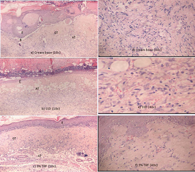 Microscopic view of the histological sections at day 7th of post-burn stained with H&E. Note the advanced regeneration and complete  organization of epidermal in the wound treated with (c) 3% TRF in contrast to the delay epidermal regeneration in (a) cream base and (b) SSD  group indicating by the presence of crusting. Meanwhile in cream base group the blistering persists, an indication of delayed epidermal repair.  Dermal proliferation was delayed in (a) cream base and (b) SSD group as compared to the (c) 3% TRF, indicated by the presence of adipose tissue  substitution. In (d) cream base and (e) SSD group, marked inflammatory response still persists. (AT: Adipose Tissue; B: Blistering; E: Epidermis; GT:  Granulation Tissue)