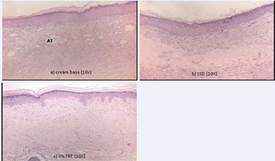 H&E stained at day 14th post-burn showing adipose tissue substitution in (a) cream base. Collagen fibers arrangement in (a) cream  base and (b) SSD were thicker and poorly aligned compared to (c) 3%TRF, which indicates a slow fibro proliferative repair. In (c) 3% TRF, less  inflammatory infiltration and normal skin morphology was observed based on the normal density and parallel orientation of a collagen fiber. This  indicates the skin for 3%TRF points towards the end of the healing process (AT: Adipose Tissue)
