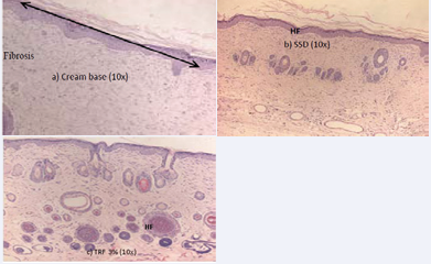 H&E stained at day 21st post-burn showing scar skin in (a) cream base group. In (b) SSD group, H&E stained showed a normal skin with  only immature hair follicle. In (c) 3% TRF group, H&E stained showed a normal skin with a mixture of immature and mature hair follicle. (HF: Hair  Follicle).