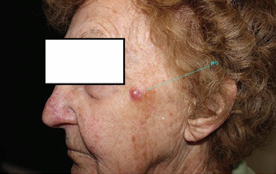 Rapidly growing 10 x14 x 4mm pink nodule on the lateral  cheek of an 87 year old woman. The lesion had reached this size in  just 3 weeks.