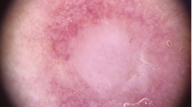  Dermatoscopic image of the lesion shown in figure 1  dominated by a central pale structure less zone with a few fine  serpentine vessels.