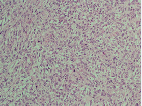 Hematoxylin and eosin (H&E) stained section taken at 40 x  magnification. The image highlights the poorly differentiated, plump  spindled cells densely packed within the neoplasm.