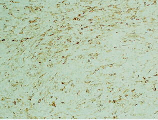 40 x magnification. The cells were focally positive when  stained with a 34BE12 (high molecular weight cytokeratin)  immunostain. Other keratinocytic markers were negative, as was the  melanoma marker S100. The findings therefore supported a diagnosis  of a poorly differentiated spindle cell squamous cell carcinoma.
