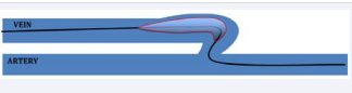Figure 1b V shape configuration-group 2, venous juxta-anastomotic stenosis and anastomosis were crossed with the same technique described in fig.1a, but the balloon was delivered and inflated only on the venous juxta-anastomtic stenosis; without any dilation of the anastomosis.