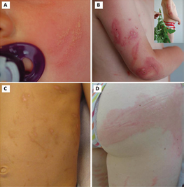 Phytophotodermatitis in our four patients.  A: Linear vesicular lesions (Case 1)  B: Erythematous bullous plaques, linear in places, linked to contact  with plant of the Herculaneum genus (Case 2)  C: Sequellar linear post-inflammatory hyperpigmentation after a  phototoxic cutaneous reaction (Case 3)  D: Urticaria plaque on the left buttock (Case 4)