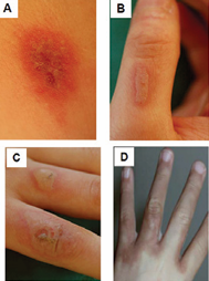 Differential diagnoses for phytophotodermatitis  A. Herpes on the neck. B and C: bullous impetigo on the hands. D:  Abuse by burns.