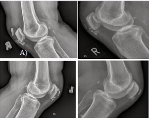 Radiographic aspect of the knee [right (A) and left (B)]  before and after [right knee (C) and left knee (D)] therapy with  extracorporeal shock wave lithotripsy and repeated injections of  sodium thiosulphate.