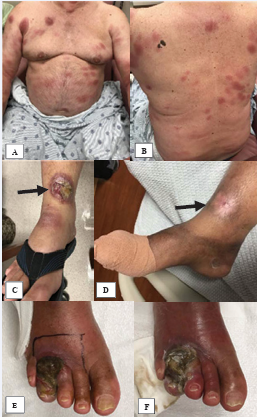  Figure 1 (A) Anterior trunk CTCL lesions (B) Posterior trunk CTCL  lesions(C) Right lower extremity ulcer prior to radiation (D) Right  lower extremity ulcer after TSEB and spot radiation (E) Ulcer on  fourth toe with brown eschar (F) The toe ulcer progressed toward  third and fifth toes.