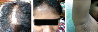 Examination of axilla showed noncicatricial alopecia with  normal skin.